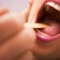 Проявление ВИЧ-инфекции в полости рта. Язык при ВИЧ-инфекции: фото