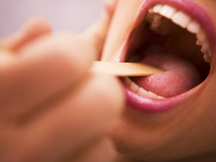 Manifestation of HIV infection in the oral cavity. Tongue with HIV infection: photo 